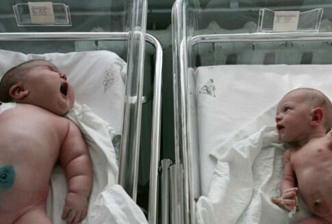 Fœtopathie diabétique chez un enfant né d'une mère atteinte de diabète gestationnel